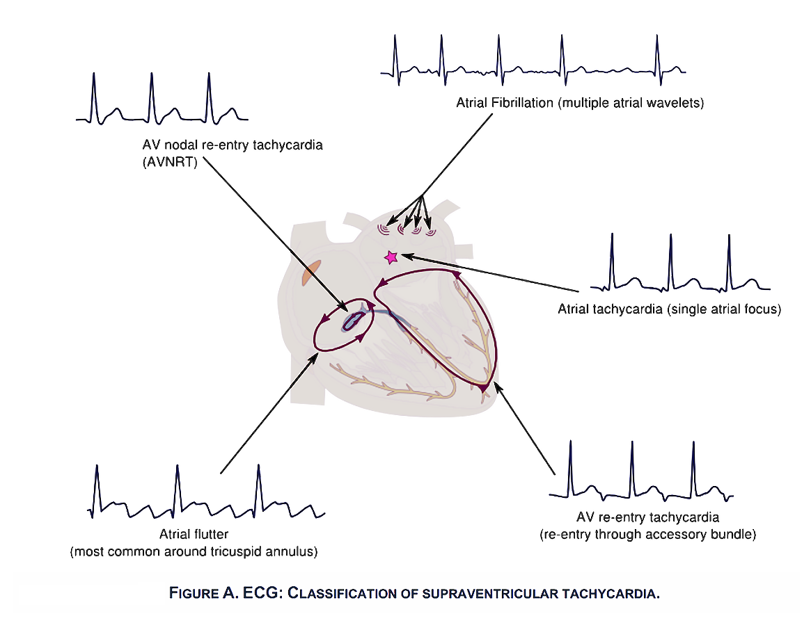 Classification of supraventricular tachycardia