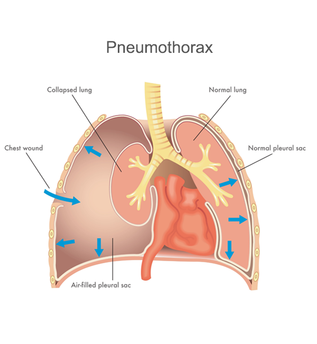 Pneumothorax