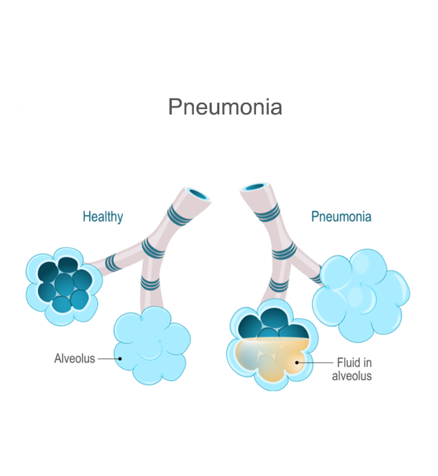 Pneumonia