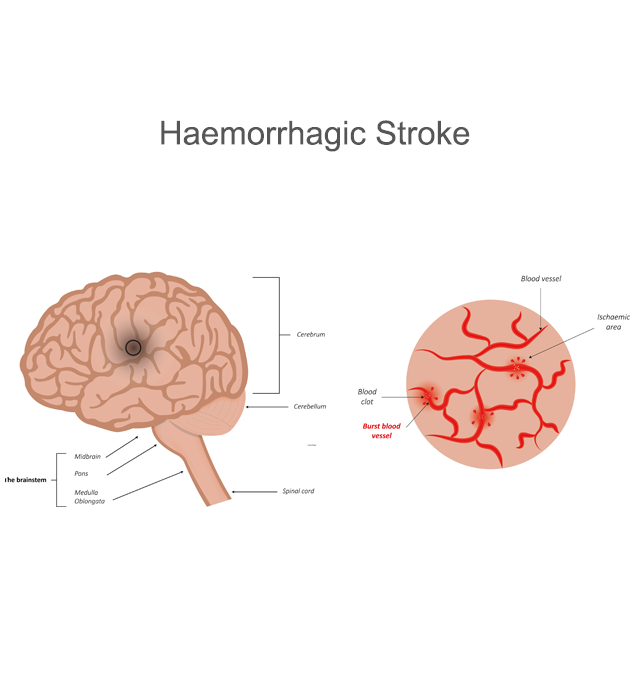 Collapsed lung - hemothorax